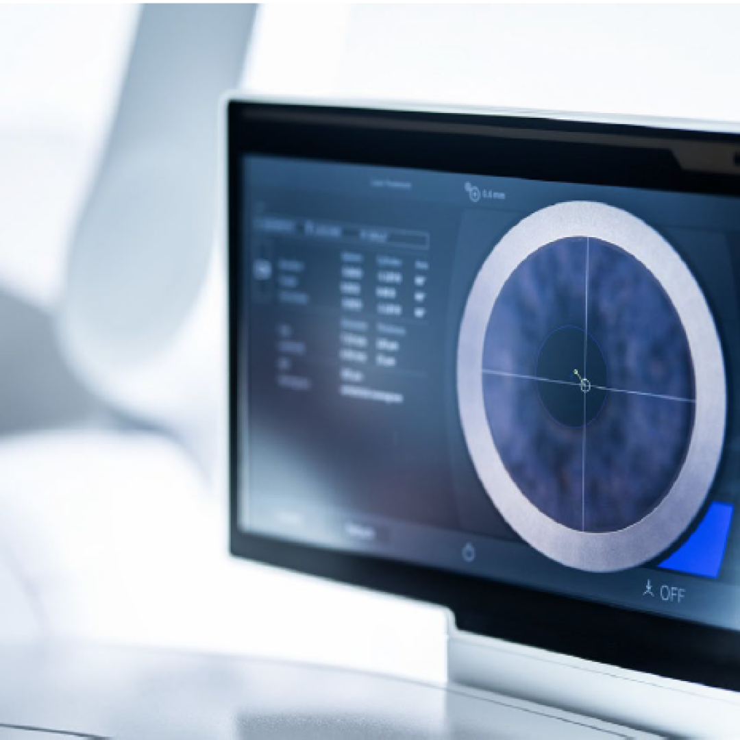 Digital screen displaying precise eye mapping and laser parameters for SMILE Pro procedure at Ciputra SMG Eye Clinic Bali.