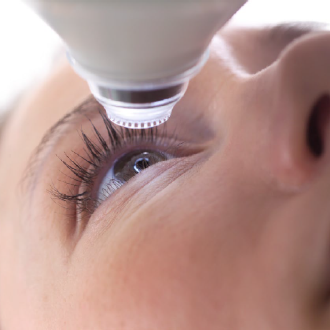 Close-up of the safe, flapless SMILE Pro laser interface during a procedure at Ciputra SMG Eye Clinic Bali.